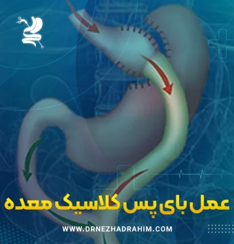 عمل بای پس کلاسیک معده ✔️ دکتر احمد نژاد رحیم