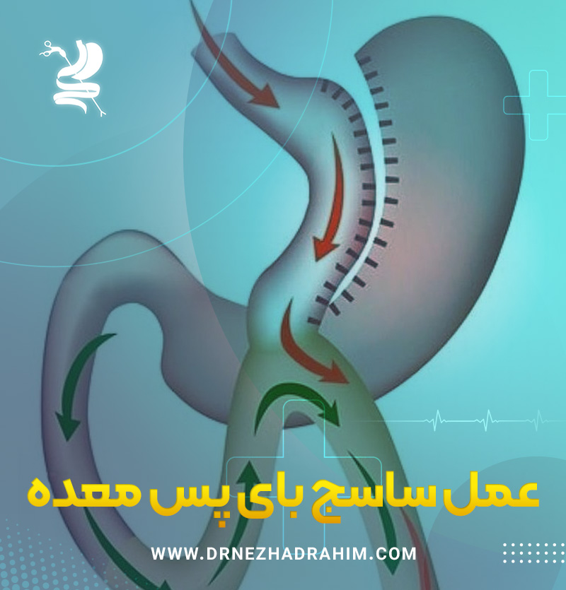 عمل ساسج بای پس معده ✔️ دکتر احمد نژاد رحیم